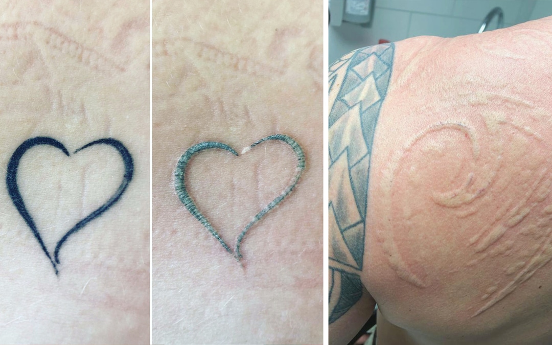 tattooentfernung berlin dr peter schulze laser
