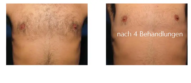 brusthaare-entfernen-lasern-laseraesthetik berlin haarentfernung brust