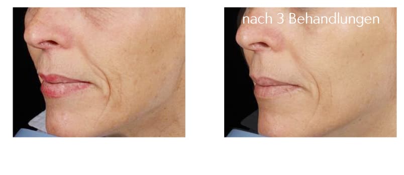 Hautstraffung Laser Lifting Gesichtsstraffung Laseraesthetik Berlin Laser Gesicht Laseraesthetik Berlin Mitte