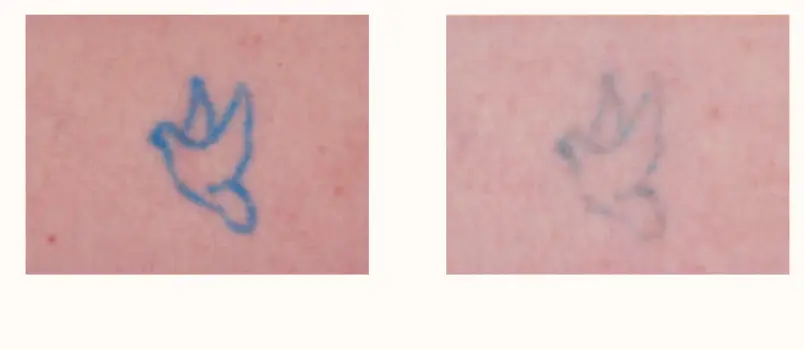 tatto-lasern-dr-schulze tattoo removal berlin laseraesthetik