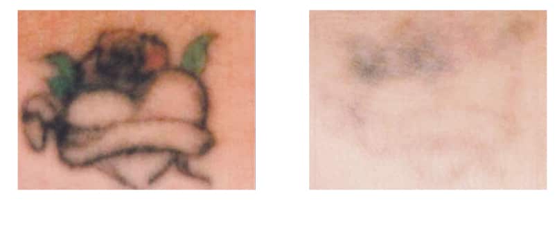 tattoo-entfernen-in-berlin tattoo removal laseraesthetik berlin