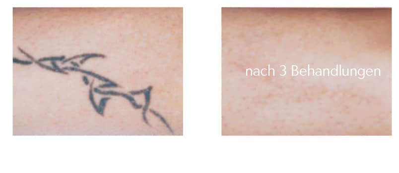 tattoo-entfernen-mit-laser-berlin laseraesthetik tattoospezialist tattoo removal