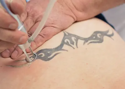 tattooentfernung berlin laser spezialist