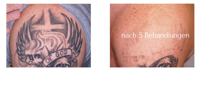 Tattoo-Entfernung mit Laser in Balingen 