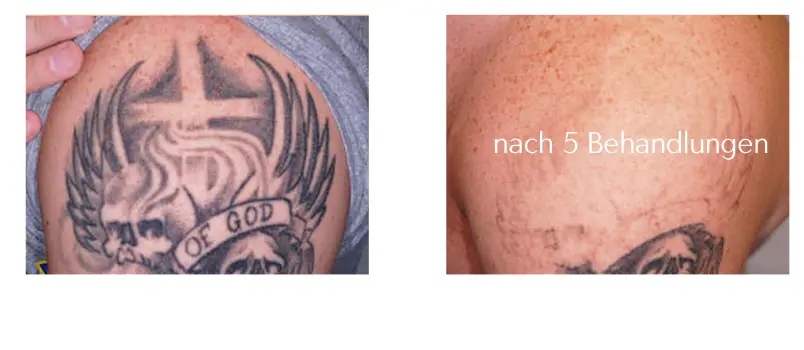tattooentfernung-tattoo-lasern-berlin tattoo removal expert prices preise laseraesthetik berlin
